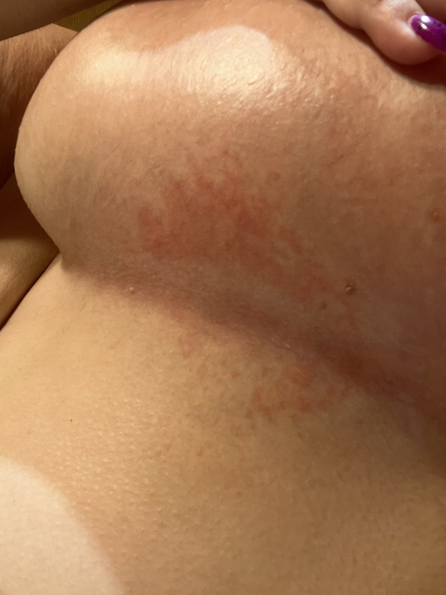 Iris_CU93's tweet photo. Mi sistema inmune está en guerra ❤️🩹
#FuckColitis 🖕🏼 #FuckPsoriasis 🖕🏼#CirujanoLlamameYa 🙏🏼 https://t.co/QyMwo24V6D