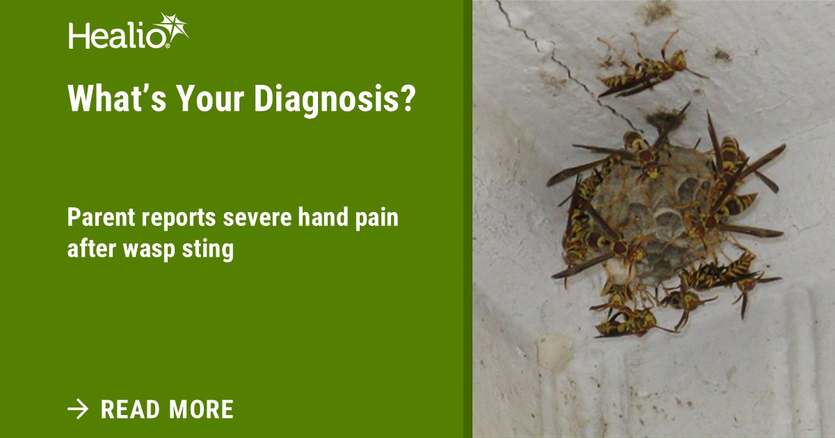 Learn how to treat insect stings in the latest installment of “What’s Your Diagnosis?” written by Dr. James Brien.

healio.com/news/pediatric…

#pediatrics #emergencymedicine