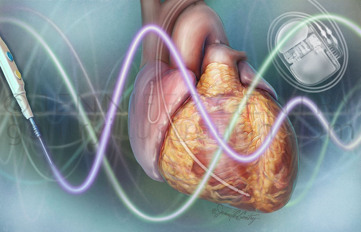 Medillustrates's tweet photo. Jennifer Gentry’s illustration for the ASA’s ACE Program visualizes how electrocautery can interfere with an implantable cardioverter-defibrillator (ICD)
Explore more: https://t.co/USqQV0KcZ7
#jennifergentry #medicalillustration #editorialillustration #cardiacsurgery https://t.co/HmeHQH0Tc9