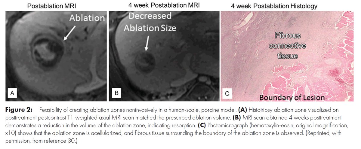 RadIC_Editor (@radic_editor) on Twitter photo 🔥Hot off the press from Radiology: Imaging Cancer:
"Development of Histotripsy as a Local-Regional Liver Cancer Therapy: Preclinical to Clinical Translation" by Worlikar et al.
Full Article: doi.org/10.1148/rycan.…
#ImagingCancer <a href="/luker_md/">Gary D Luker MD</a> 🔥Hot off the press from Radiology: Imaging Cancer:
"Development of Histotripsy as a Local-Regional Liver Cancer Therapy: Preclinical to Clinical Translation" by Worlikar et al.
Full Article: doi.org/10.1148/rycan.…
#ImagingCancer <a href="/luker_md/">Gary D Luker MD</a>