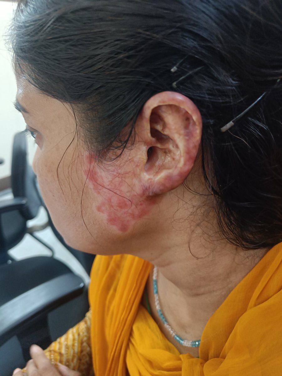 Diagnosis....??
<a href="/ArunInamadar/">Arun C Inamadar MD , FRCP (Edin), FRCP(London)</a> 
<a href="/Doctors__squad/">Dr Honey choudhary 🩺</a> 
<a href="/drsthanus/">Dr sthanu subramanian</a>