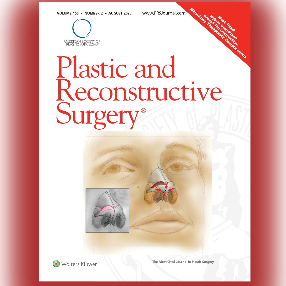 📢 Hot off the press: The August 2025 issue of PRS is here! 🎉

The cover image comes from, “The Soft Triangle Tension Graft,” by Ghavami, Vranis, and Villanueva: bit.ly/RhinoSTTG

#plasticsurgery #hotoffthepress #prsjournal
