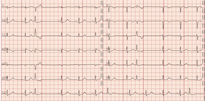 31 y/o 👩 with frequent, highly symptomatic PVCs refractory to flecainide.

🫀 site of origin?