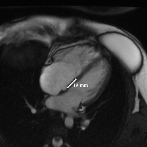 Ritika Tuli (@ritikatulimd) on Twitter photo 🫀 #CardioNugget: 
Ebstein Anomaly on cMRI
Ebstein anomaly = apical displacement of the septal tricuspid valve + atrialized RV.
🔍 cMRI Features:
- Apical septal TV displacement ≥8 mm/m² BSA (4-chamber view)
- Atrialized RV = portion of RV proximal to TV acts like RA
- Leaflet 🫀 #CardioNugget: 
Ebstein Anomaly on cMRI
Ebstein anomaly = apical displacement of the septal tricuspid valve + atrialized RV.
🔍 cMRI Features:
- Apical septal TV displacement ≥8 mm/m² BSA (4-chamber view)
- Atrialized RV = portion of RV proximal to TV acts like RA
- Leaflet