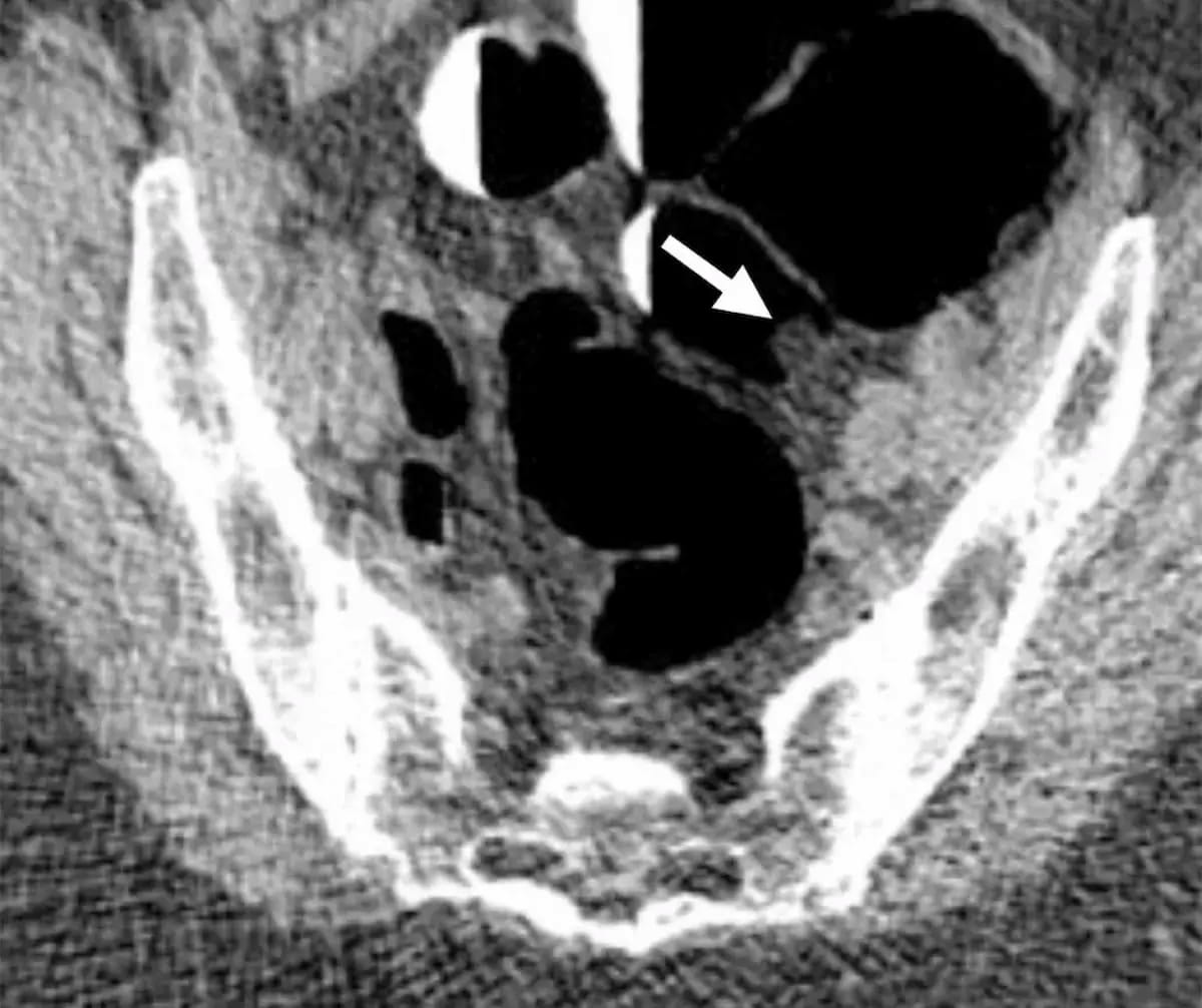 Twenty Years of CT Colonography for #ColorectalCancer Screening: What the Research Reveals
diagnosticimaging.com/view/twenty-ye…
<a href="/RadiologyACR/">American College of Radiology</a> <a href="/ARRS_Radiology/">ARRS</a> <a href="/RSNA/">RSNA</a> <a href="/SocietyAbdRad/">Society of Abdominal Radiology | SAR</a> <a href="/YaleRadiology/">Yale Department of Radiology & Biomedical Imaging</a> <a href="/MontefioreRAD/">Montefiore Radiology</a> <a href="/PennRadiology/">Penn Radiology</a> <a href="/Hopkins_Rad/">Johns Hopkins Radiology</a> <a href="/BrighamRad/">Brigham and Women's Radiology</a> <a href="/UABRadiology/">UAB Radiology</a> 
#radiology #RadRes #CTRad