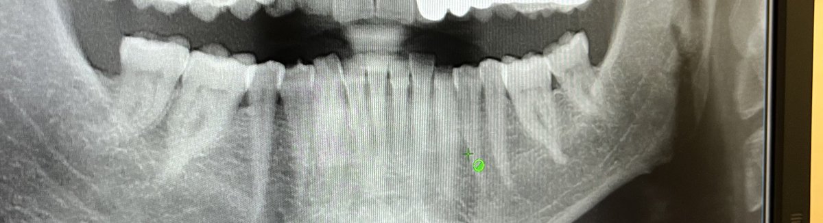 Bağdaş kuran kökler 🫢🦷