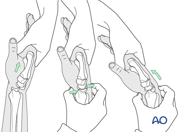 MoAImam's tweet photo. A perilunate dislocation occurs when a carpal bone is dislocated relative to the lunate, not to be confused with a lunate dislocation ! 

https://t.co/uuDisgYvJh https://t.co/O9wiD4lEPa