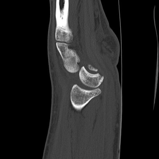 MoAImam's tweet photo. A perilunate dislocation occurs when a carpal bone is dislocated relative to the lunate, not to be confused with a lunate dislocation ! 

https://t.co/uuDisgYvJh https://t.co/O9wiD4lEPa