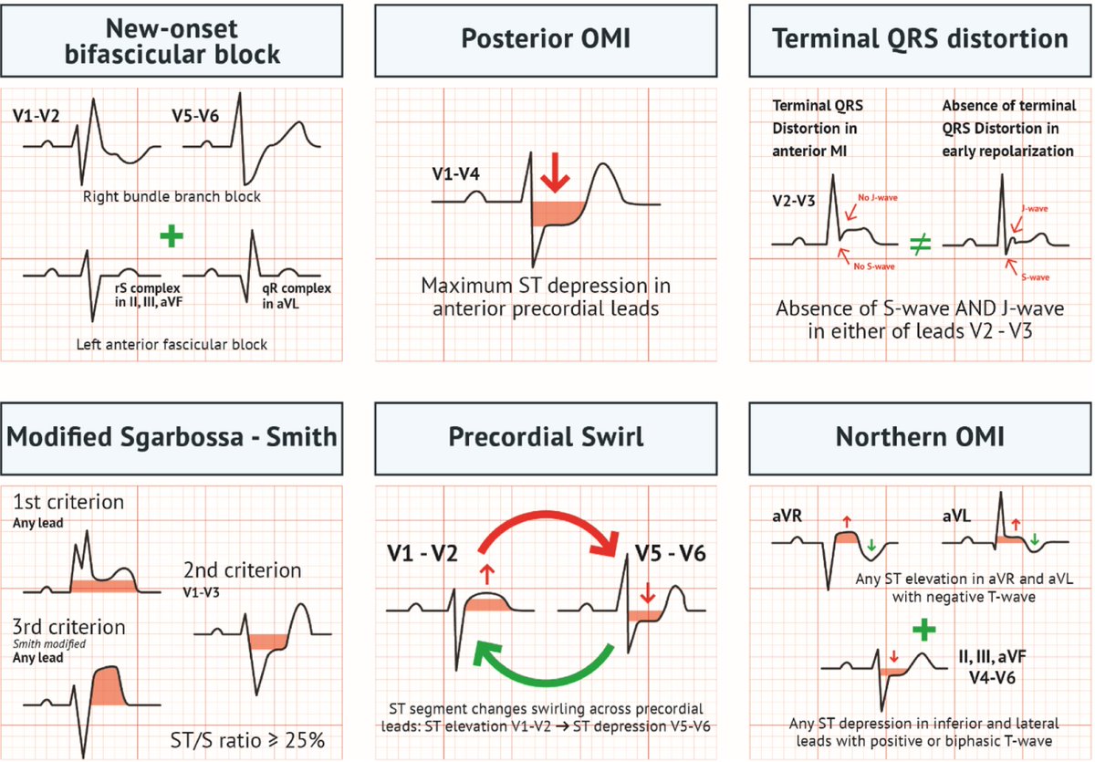 🔍 ¿Sabías que un infarto oclusivo puede no mostrar el típico supradesnivel del ST?

Algunas oclusiones se manifiestan con patrones muy sutiles

Detectarlos a tiempo puede marcar la diferencia. 🚑

🧵 En este hilo te explico cuáles son y cómo reconocerlos 👇