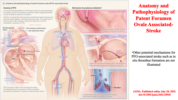 drraviele's tweet photo. 📌 Patent Foramen Ovale &amp; Risk of Stroke 🧠
👉 2025 Review
#PFO #CardioTwitter #MedTwitter #Stroke #Review @DrMarthaGulati @ZHeart11768530 @AnastasiaSMihai @TJaredBunch @DrJasonAndrade @DhirajGuptaBHRS  @cpgale3 @SposatoL @SeguraCardio @Hragy @mmamas1973 @ErinMichos @adribaran https://t.co/VdR8Fs0NM3