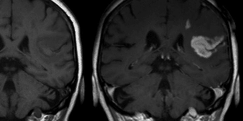 Early anticoagulation after stroke decreases recurrence without increasing bleeding in patients with atrial fibrillation dlvr.it/TMBJSq #Cardiology #ChronicDisease