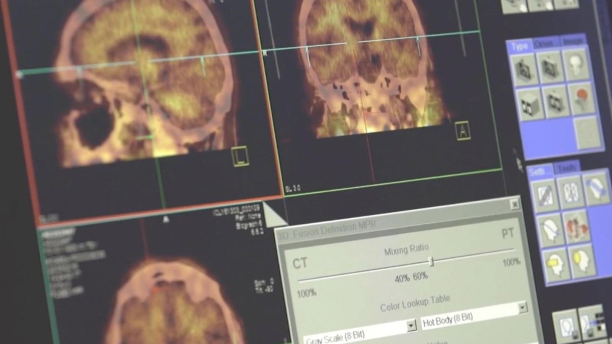 🔴🇮🇷 Radiofármaco iraní detecta el Alzheimer 20 años antes de su aparición

🔸 Científicos nucleares iraníes han desarrollado con éxito un radiofármaco capaz de diagnosticar el Alzheimer hasta 20 años antes de que aparezcan los síntomas.

🔗 hispantv.com