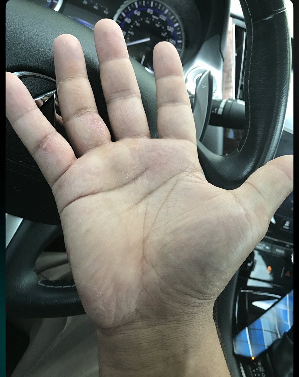 <a href="/NFCreeps/">Creepy Steve - NFC</a> Almost forgot to share 

Back in 2017 a pitbull nearly ripped my finger off 

When it healed it healed crooked