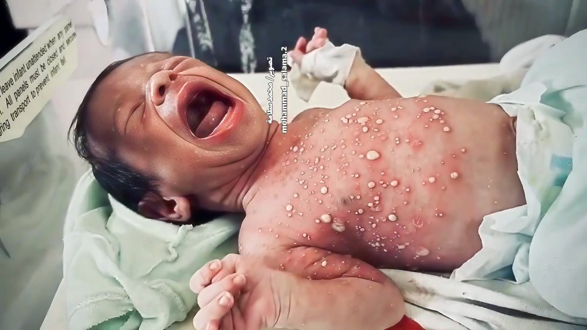 This is the horrific reality of genocide: a newborn baby in Gaza suffering from a skin infection due to extreme heat, lack of hygiene, and neglect, crying out in pain.
