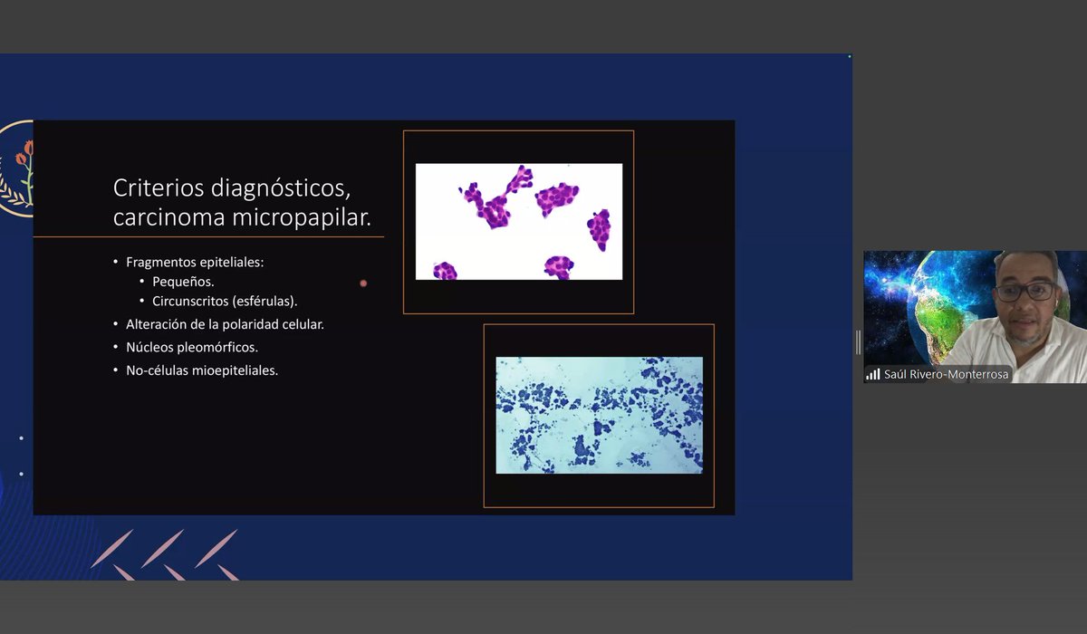 MonicaGarciaBuitrago (@monicagarciabu2) on Twitter photo Continuamos descubriendo las claves diagnosticas en #BreastCytology con Dr. <a href="/saul_path/">Saúl RM Path</a> 🔬💉<a href="/UMiamiPathology/">UMiami Pathology</a>
<a href="/CarmenGomezMD/">Carmen Gomez-Fernandez, MD</a> <a href="/MerceJorda1/">Merce Jorda</a>
<a href="/jalithsoler/">IVONNE JALITH SOLER CALVO</a>
<a href="/martin_poveda82/">Martin Poveda</a>
#Patho #citologia #rose
<a href="/IACytology/">International Academy Cytology</a> Continuamos descubriendo las claves diagnosticas en #BreastCytology con Dr. <a href="/saul_path/">Saúl RM Path</a> 🔬💉<a href="/UMiamiPathology/">UMiami Pathology</a>
<a href="/CarmenGomezMD/">Carmen Gomez-Fernandez, MD</a> <a href="/MerceJorda1/">Merce Jorda</a>
<a href="/jalithsoler/">IVONNE JALITH SOLER CALVO</a>
<a href="/martin_poveda82/">Martin Poveda</a>
#Patho #citologia #rose
<a href="/IACytology/">International Academy Cytology</a>