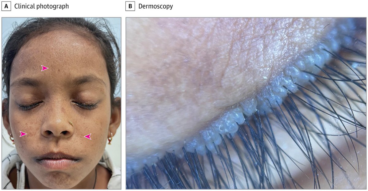 String of Pearls of the Eyelid in a Child Aged 9 Years - Via <a href="/JAMAOphth/">JAMA Ophthalmology</a> 
Case report: A diagnosis of lipoid proteinosis in a child aged 9 years who presented with atrophic facial scars and beaded papules along the eyelid margins bilaterally.
jamanetwork.com/journals/jamao…