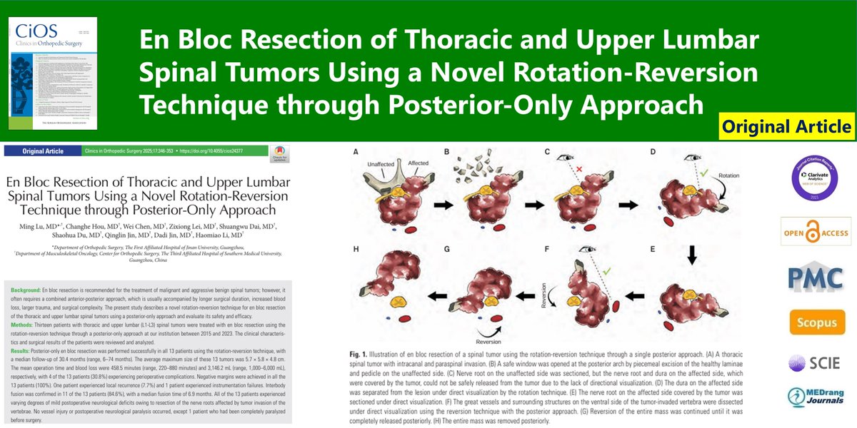 CiOSjournal's tweet image. En Bloc Resection of Thoracic and Upper Lumbar Spinal Tumors Using a Novel Rotation-Reversion Technique through Posterior-Only Approach
🌷doi.org/10.4055/cios24…
2025 Apr;17(2) Ming Lu
#Spinal_tumor #Surgical_resection #En_bloc_resection #Surgical_margin #Surgical_technique