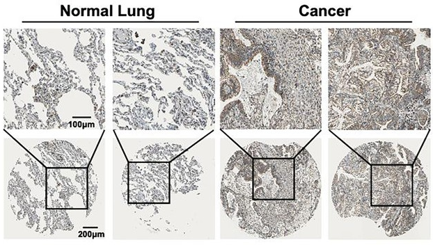 Pulmonary Cell News (@pulmonary_news) on Twitter photo This <a href="/eLife/">eLife - the journal</a> study reports that phosphodiesterase 1A (PDE1A) promotes metastasis in #NSCLC cells, and PDE1A overexpression is correlated with #angiogenesis and poor outcomes of NSCLC patients.
π³οΈ Dig into the details: bit.ly/45pYor8 This <a href="/eLife/">eLife - the journal</a> study reports that phosphodiesterase 1A (PDE1A) promotes metastasis in #NSCLC cells, and PDE1A overexpression is correlated with #angiogenesis and poor outcomes of NSCLC patients.
π³οΈ Dig into the details: bit.ly/45pYor8