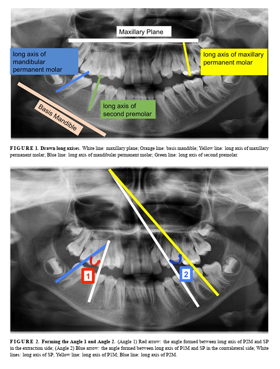 JOCPD_1974's tweet photo. Study finds extraction timing of permanent first molars impacts neighboring teeth tipping, with dental age key for optimal occlusal maintenance. ๐ฆท #PediatricDentistry #MolarExtraction
Read more:https://t.co/1hGTP7Jj8U https://t.co/RTORBVRkQa