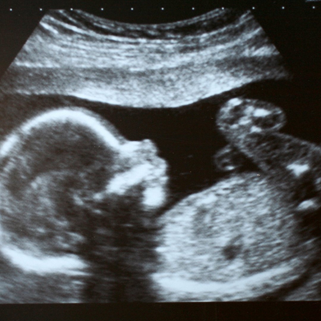 Abortion is when a baby gets the death penalty for someone else's actions.