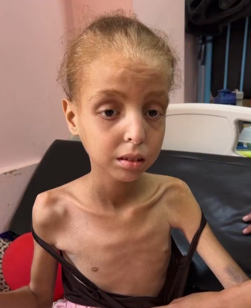 طفلة في غزة تتحلل بصمت أمام أعين العالم، وزنها لم يتجاوز 15 كيلو، ليس بسبب مرض نادر، بل بسبب الجوع وحده. جسدها الصغير تحول إلى هيكل عظمي، وعظامها باتت تبرز إلى الخارج من شدة الهزال، وكأنها تصرخ بلا صوت.