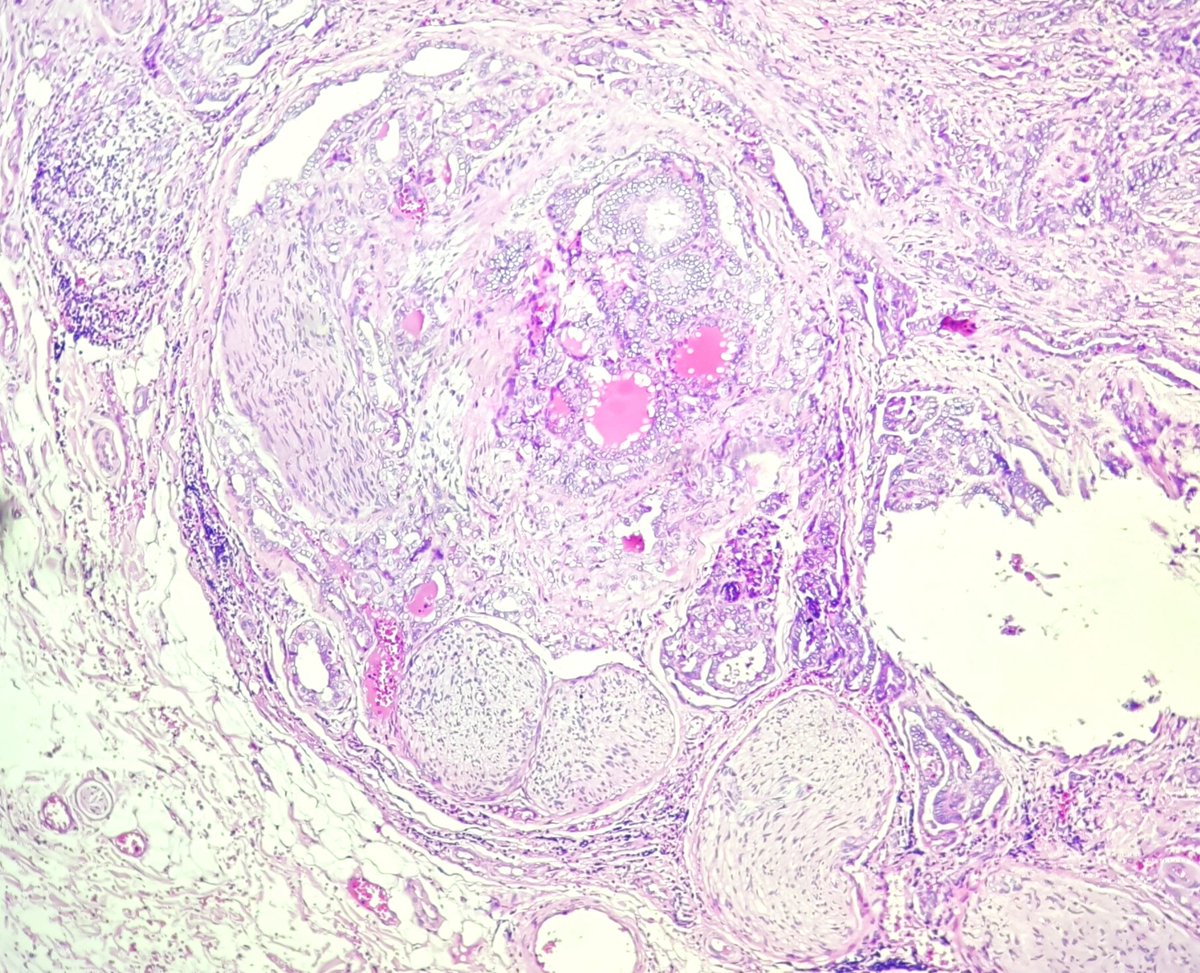 Unusual perineural invasion in papillary thyroid carcinoma. The patient also had extrathyroid extension with gross strap muscle and hypopharynx invasion. Associated with aggressiveness.
#pathology #Thyroid_path #PTC #PNI