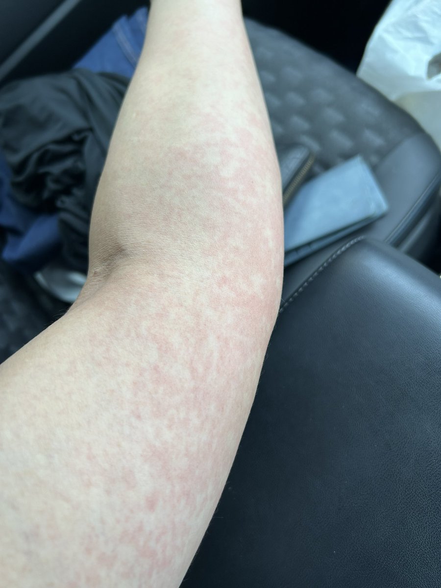 mi0ura5844's tweet image. 絶賛、皮膚バグり中‼️

なんやこれ？？

自然治癒力に期待します！

#皮膚
#ぶつぶつ