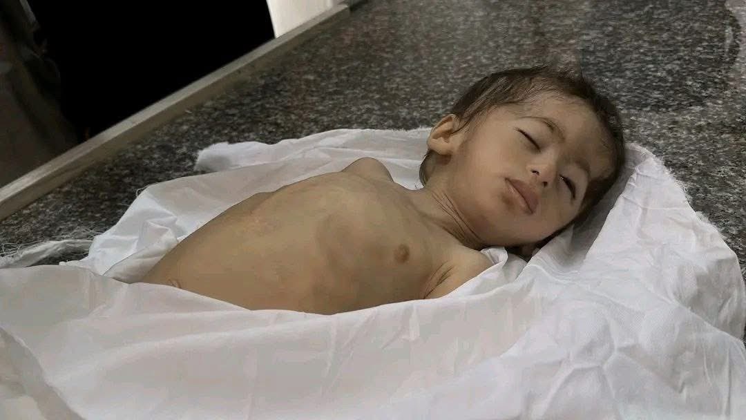 Number of martyrs from hunger in Gaza: 148
Among them: 89 children who needed only milk, food, and a living conscience