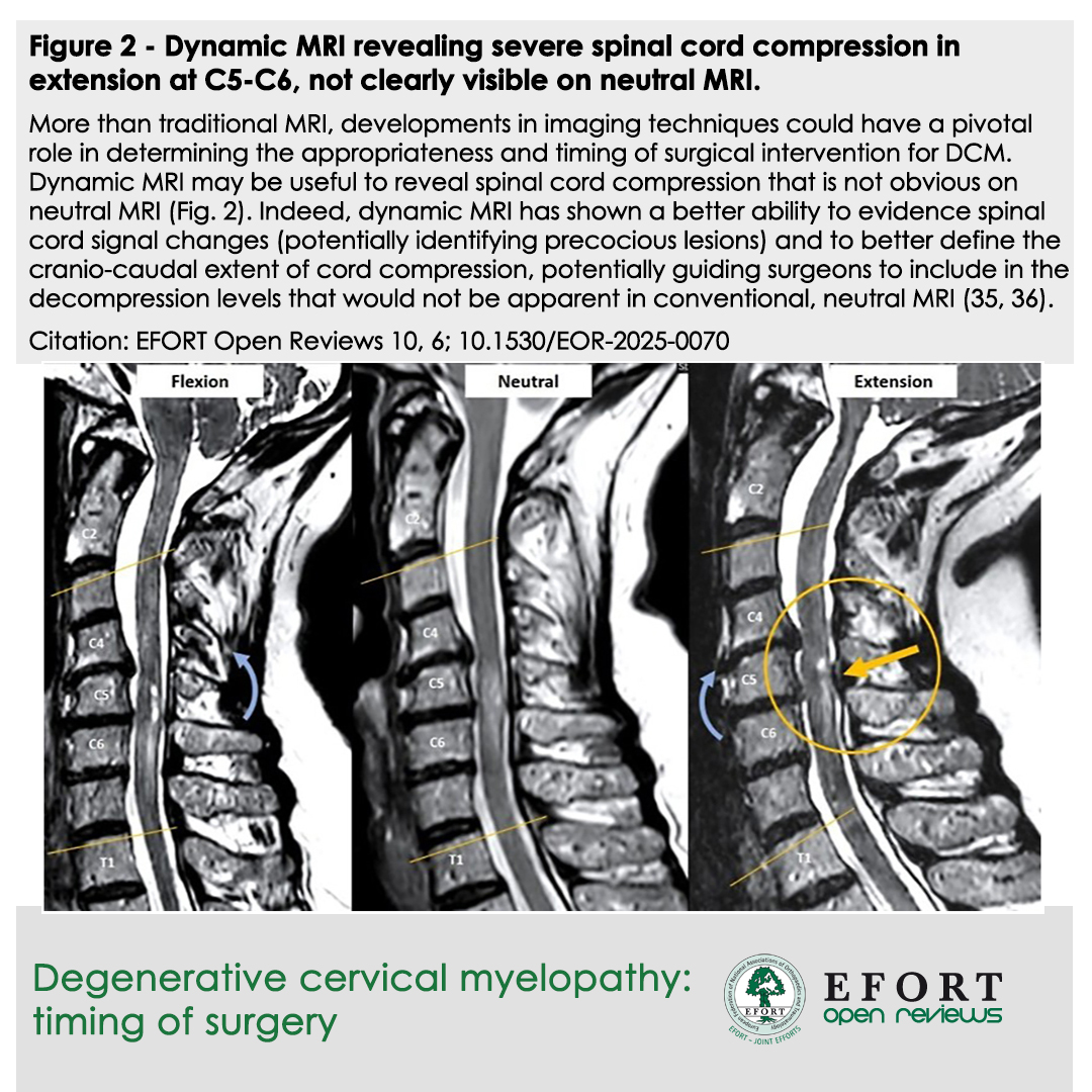 New #EOR June 2025: #DCM surgical timing! 🧠⏱️ Review covers "grey zone" pts. Early surgery for mild DCM improves QoL/function but has risks. Advanced #MRI &amp; specific risk factors help decision-making. Don't miss this! 🔗 bit.ly/EOR250610
#EFORT #EORJournal #SpineSurgery