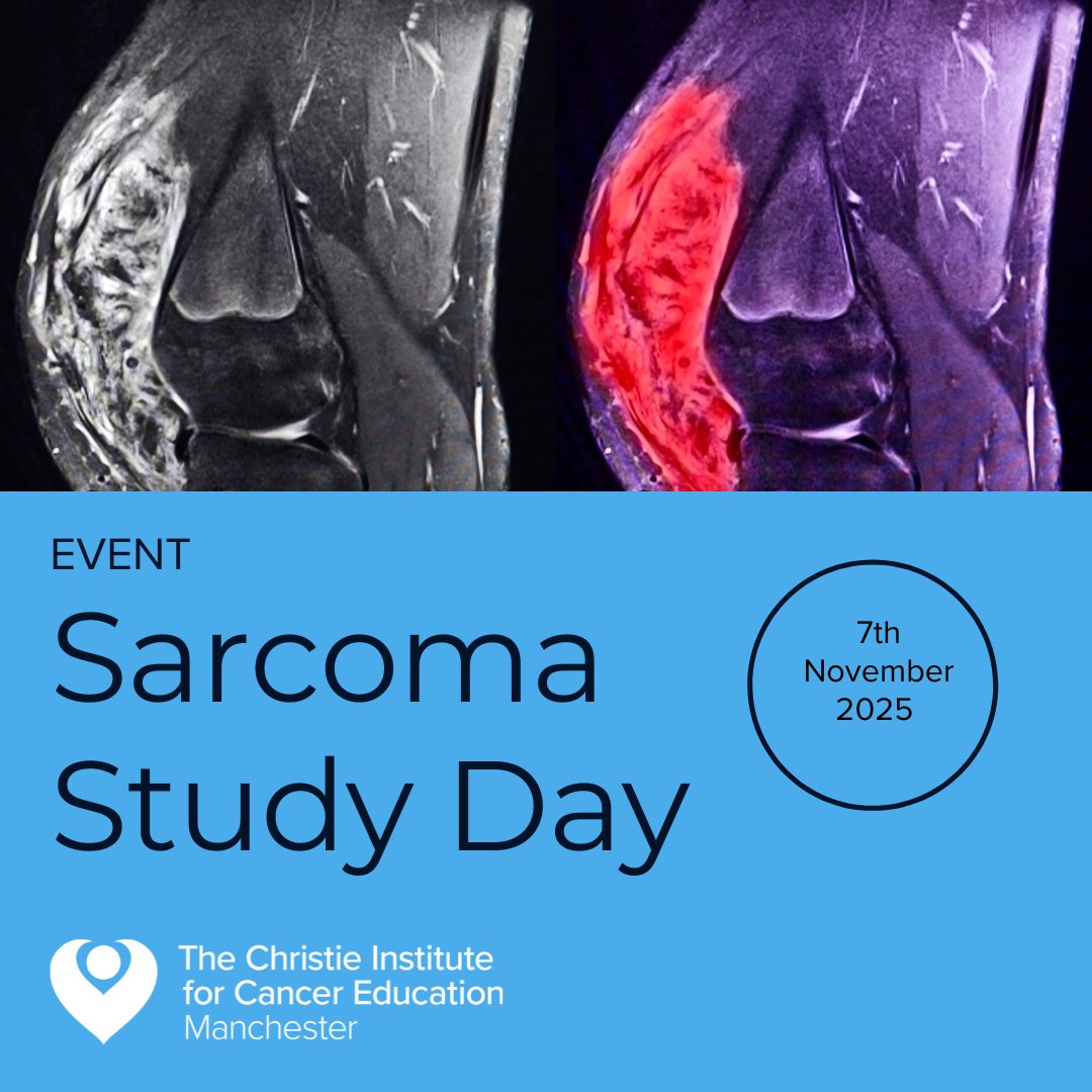 Sarcoma is rare knowing the signs can save lives.
5 key insights
1️⃣ Rare &amp; diverse (bone, muscle, fat, nerves)
2️⃣ Two main types: soft tissue &amp; bone
3️⃣ Painless lump = common early sign
4️⃣ Diagnosis needs scans + biopsy
5️⃣ Treatment = team approach
🔗 ow.ly/qaB750WrKk8