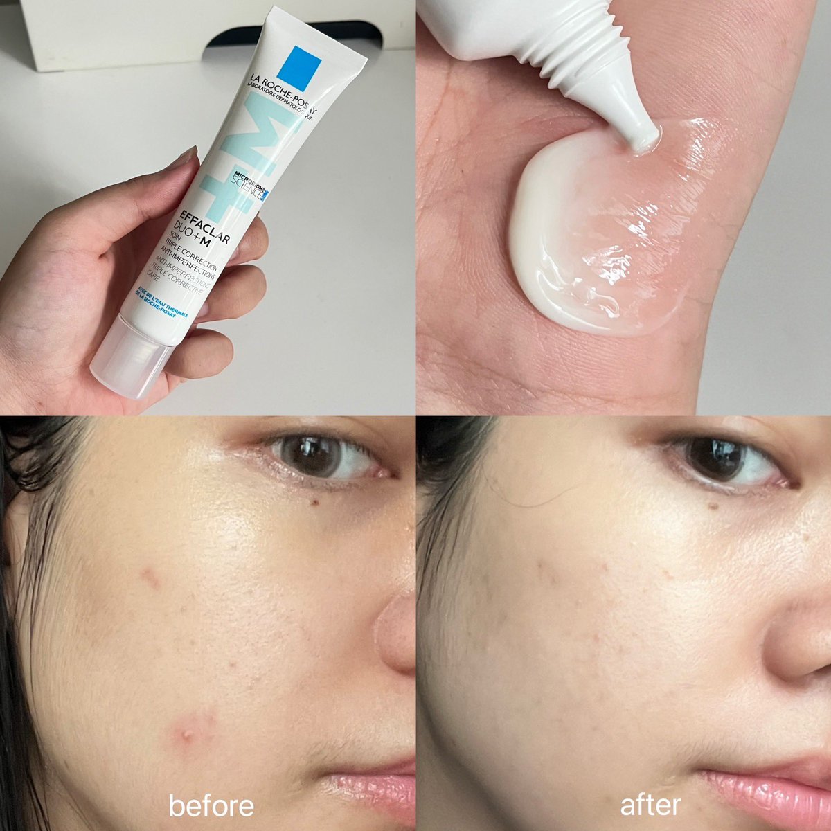 มอยส์เจอร์ไรเซอร์สำหรับคนเป็นสิวนี่ยกให้ La Roche-Posay Effaclar Duo+M เลยย ตัวนี้ใช้ช่วงที่เป็นสิวอักเสบ คือสิวแห้งไวมากกก รอยสิวเก่าๆ ก็จางลงด้วย จะไม่หนักหรือแรงเท่าพวกเซรั่ม ซึ่งนี่ชอบมาก คนมีสิวควรลองอะ แนะนำจริงง