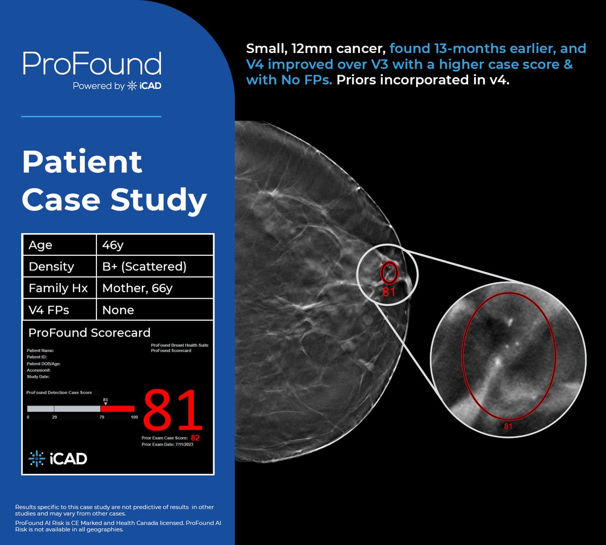 [#PatientCaseStudy] This 46-year-old woman with scattered fibroglandular densities for screening.

✨ ProFound AI Detection V4 integrated her prior exam, and it marked a case score of 81 and two marked lesion scores of 81 and 60 with zero false positives.

bit.ly/4o3CmSk