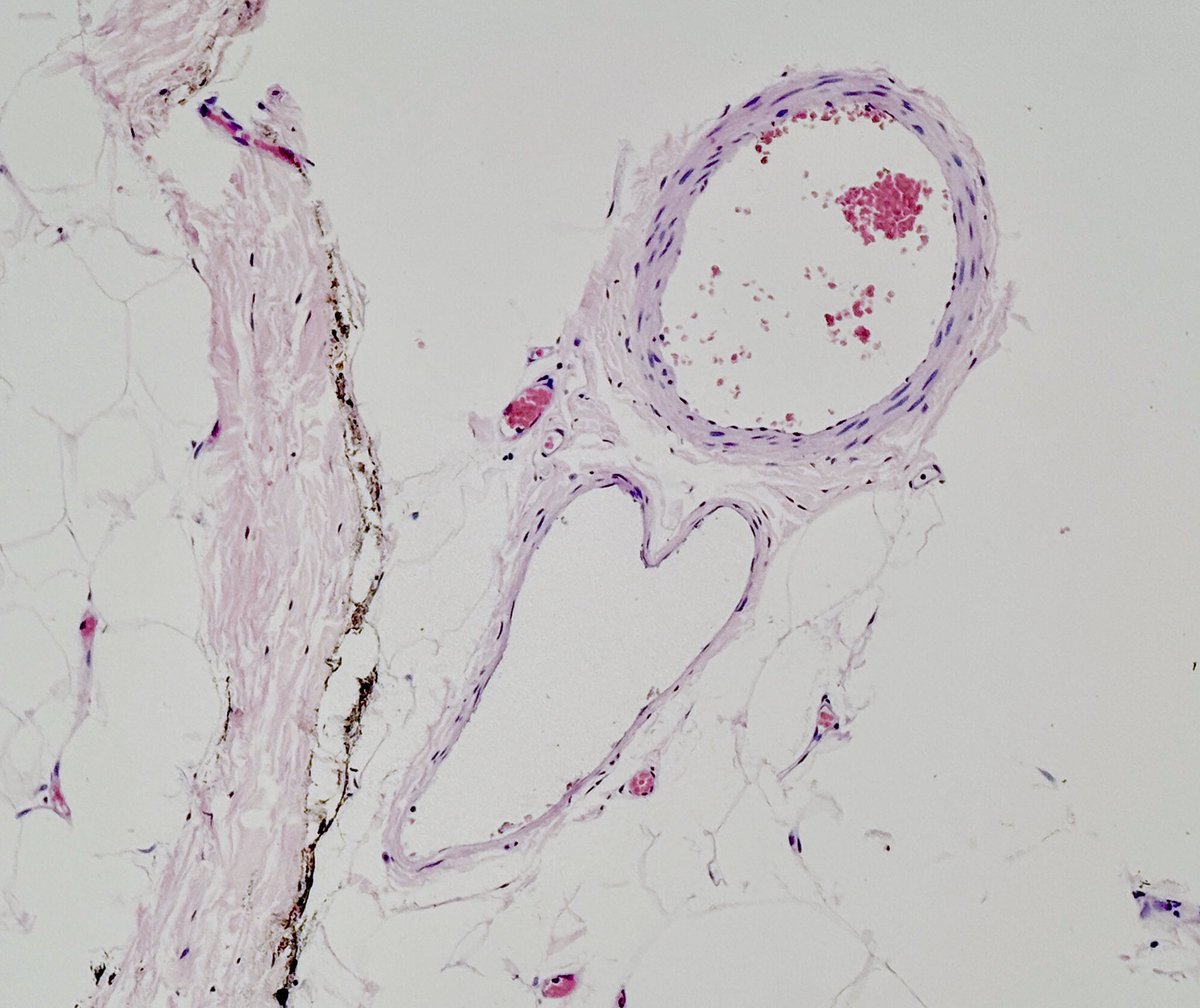 It must have been love……😅
#pathology
#histology 
#Roxette #1980s