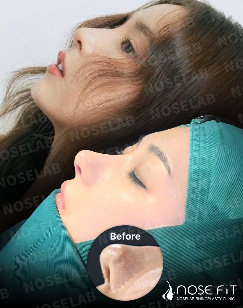 korea_glory's tweet photo. ワーピングと凹凸感があった自己肋軟骨の限界を『ノーズフィット（Nosefit）』が克服しました。
ノーズラボ独自のAI＋3Dモールド技術により、自己肋軟骨でもシリコンのように滑らかで理想的な形を実現できるのが #ノーズフィット です。

AIが顔のCT画像・皮膚の厚み・軟骨の構造を解析し、3Dプリンターで作られた専用モールドに肋軟骨の粒子を精密に充填・硬化させます。

さらに、幹細胞と高濃縮成長因子を併用することで、吸収率や炎症リスクを最小限に抑え、生着率を高めています。

従来の自己肋軟骨を使った鼻整形は、軟骨を粉砕して筋膜に包む方法や固定フレームを使う「第一世代」の技術が主流でした。

これらも安全性は高いものの、凹凸や吸収、ワーピング及び左右非対称が生じるケースもありました。

ノーズフィットは、こうした課題を精密に補完するために開発された独自の技術です。

また、すべての手術はクローズ法で行われるため、

✔️鼻柱の切開が不要で傷跡が残らず

✔️腫れ・内出血・痛みが少なく

✔️拘縮や再手術のリスクも大幅に低減されます。

自己組織による自然な仕上がりを希望する方にとって、

ノーズフィットは最も科学的で進化した選択肢となるでしょう。

#ノーズラボ #ノーズフィット #Nosefit #鼻整形 #鼻再手術 #鼻再建手術 #鼻拘縮 #クローズ法 #カンチャヨン院長 #3D鼻整形 #AI鼻整形 #幹細胞治療 #自己肋軟骨 #韓国整形 #ソウル整形
