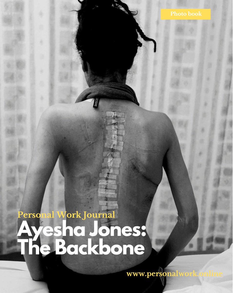 magnetoJJ's tweet image. As a passion project I run personalwork.online - sharing the #personalprojects of photographers. This week&apos;s interview is @Ayesha_Jones, featuring Backbone her project on #scoliosis

#documentaryphotography