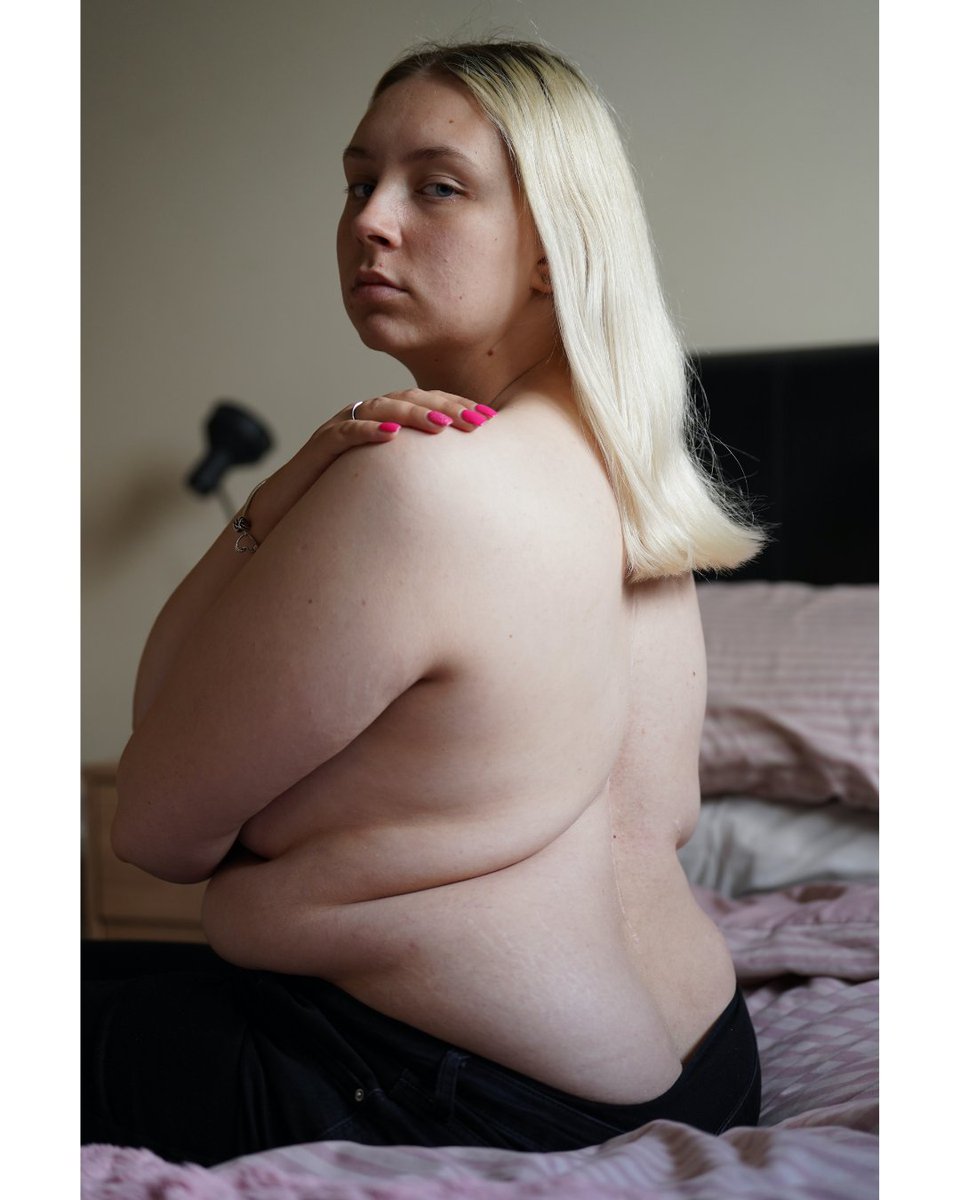 magnetoJJ's tweet image. As a passion project I run personalwork.online - sharing the #personalprojects of photographers. This week&apos;s interview is @Ayesha_Jones, featuring Backbone her project on #scoliosis

#documentaryphotography