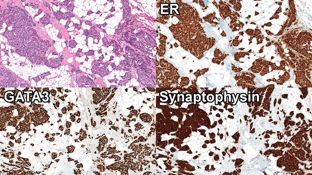 Case of Neuroendocrine Tumor (NET) of Breast 🔬

Neuroendocrine pattern shows some features of neuroendocrine differentiation and is challenging to diagnose, as up to 30% of IDC show some degree of neuroendocrine differentiation—so here’s an NET.

#PathX #PathTwitter #breastpath