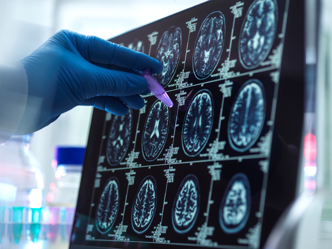 🧬Científicos del #CSIC participan en la obtención de la escala de riesgo genético de #alzhéimer más completa

🧠Un equipo internacional ha combinado estudios genéticos de cerca de 100.000 personas sanas y enfermas en Europa, Asia, África y América

➡️ tiny.cc/11iq001