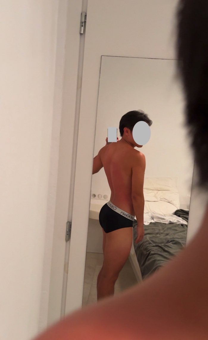 sgunibb's tweet photo. okay what do i do about this sunburn 😭 https://t.co/E3gb1pdMsu