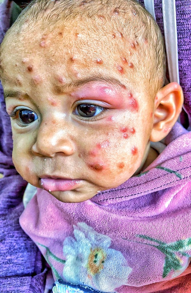 mahmoud60013's tweet photo. This might be my last message. Tasneem is the most precious thing I have. I can't see her silent pain. The wounds and blisters that spread faster than she can bear. A burning sensation that burns her skin like hot coals, making her eyes swell, puff and hurt. An itching that tears her night and day apart, and tears that won't dry. She finds no rest or sleep. Tasneem is waiting for you. Tasneem needs urgent treatment.
https://t.co/TMSOroX06V