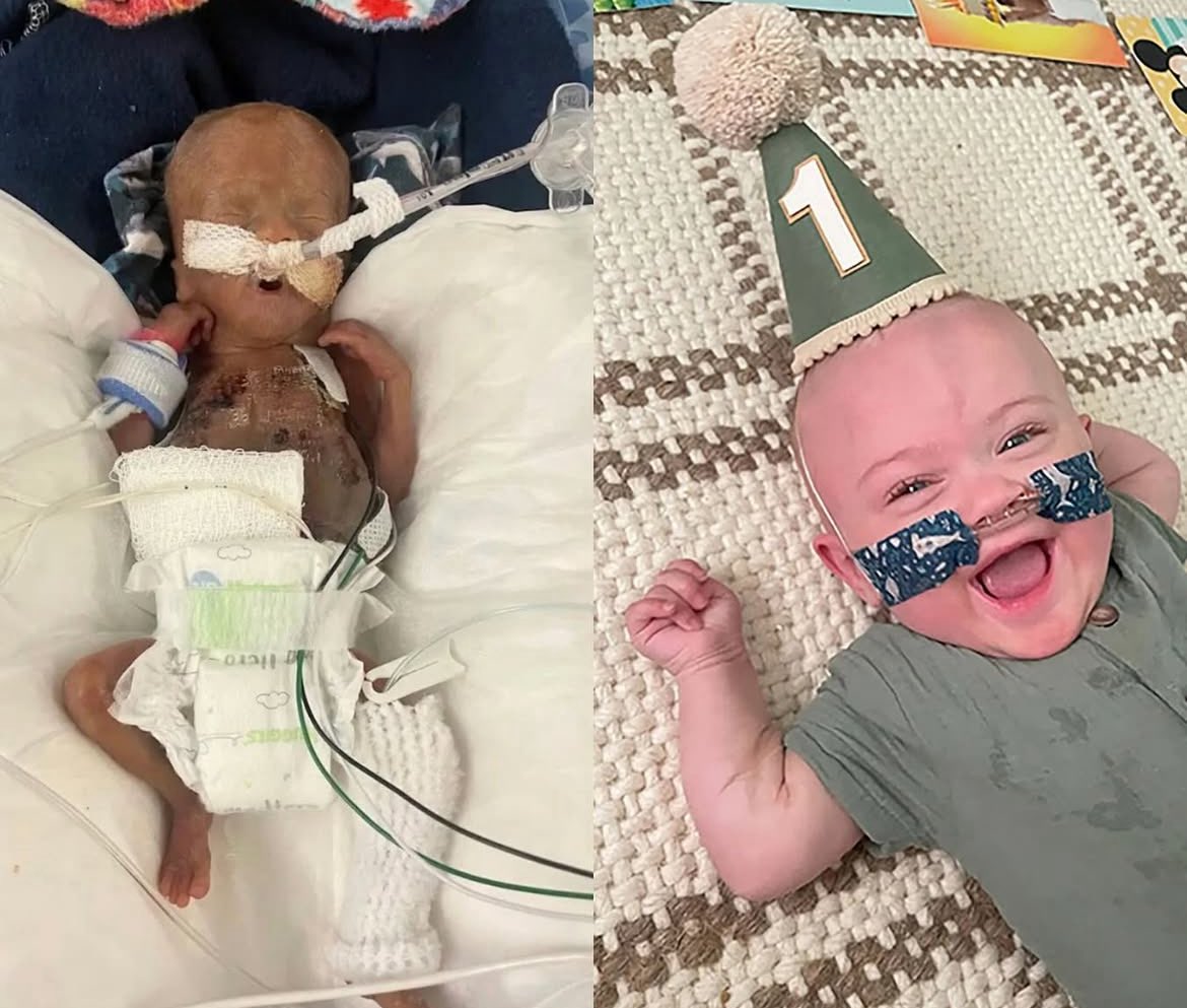 The world’s most premature baby celebrates his 1st birthday.