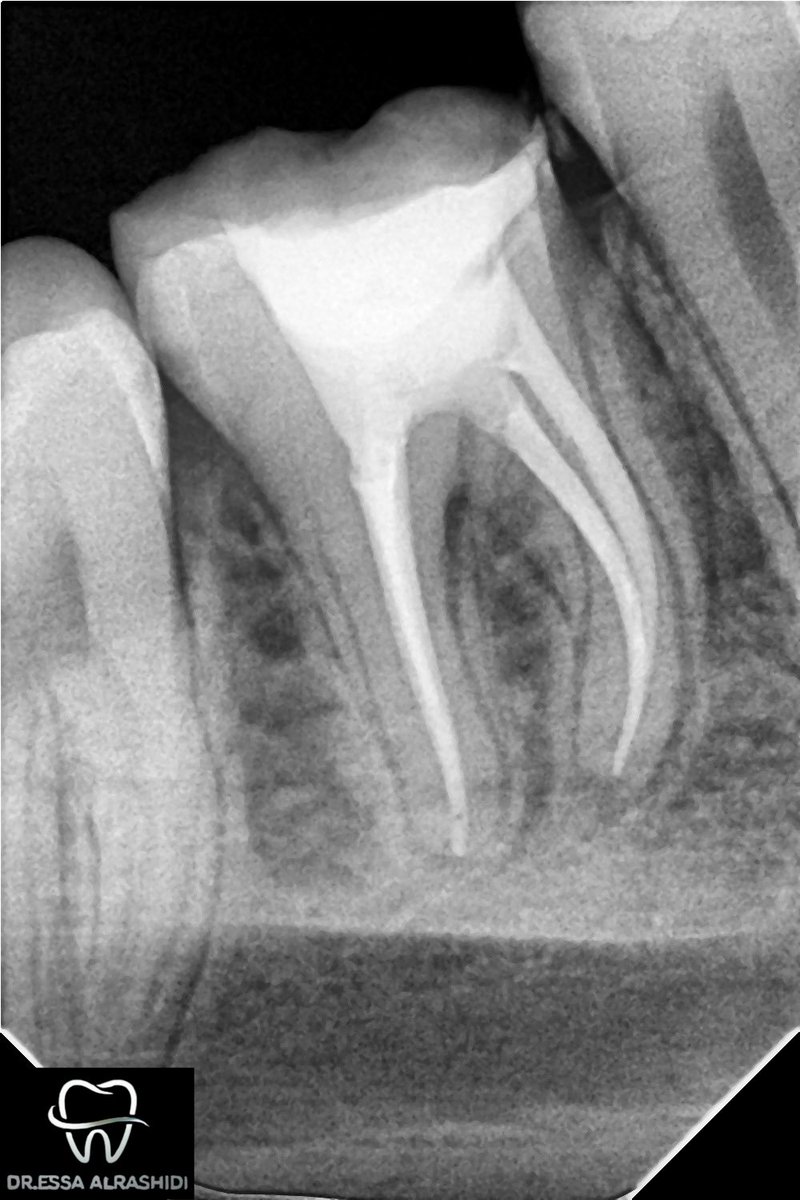 #Case_of_the_day

- #46 with SIP، RCT done with 4 canal + composite restoration done