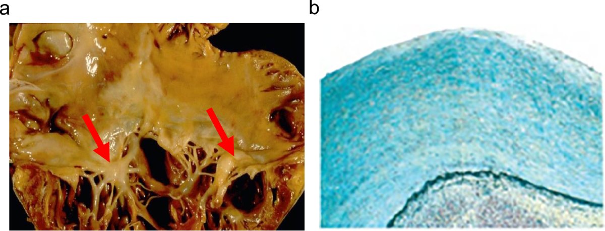 OncTheraX's tweet photo. 🧬 Carcinoid heart disease: how to manage it. A practical guide for the clinician

📚 By Daniela Cardinale &amp; Chiara Maria Grana
🗞️ 𝘊𝘭𝘪𝘯𝘪𝘤𝘢𝘭 𝘢𝘯𝘥 𝘛𝘳𝘢𝘯𝘴𝘭𝘢𝘵𝘪𝘰𝘯𝘢𝘭 𝘐𝘮𝘢𝘨𝘪𝘯𝘨
🔗 Read the article: https://t.co/XzQ7hRyFBO

#Cardiology #NeuroendocrineTumors https://t.co/152XtYFyvE