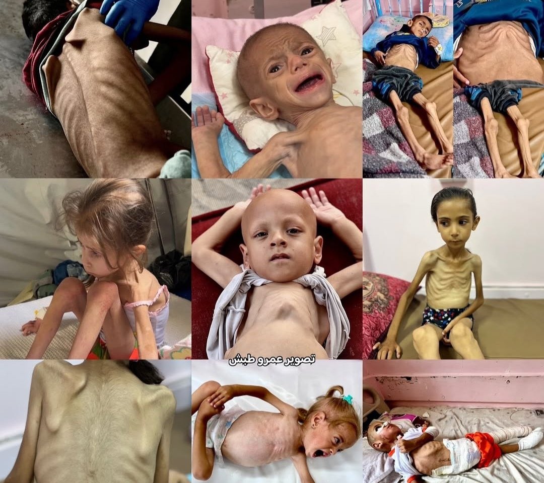 Gazze'de çocukların açlıktan son hali..