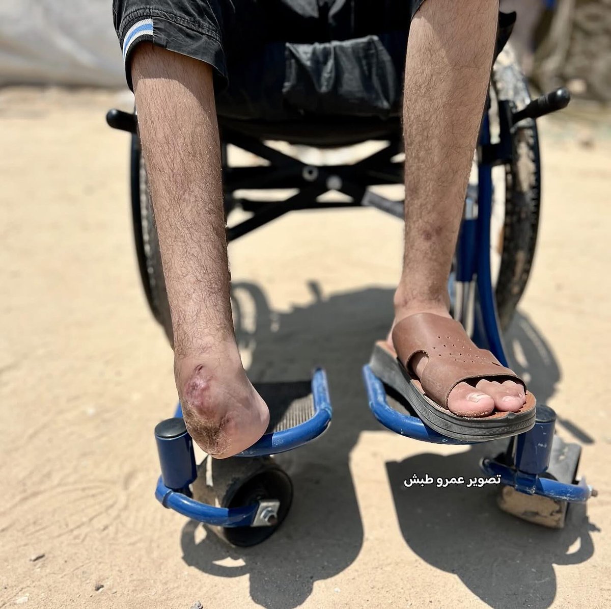 From childhood football fields to the crutch of war, Ubaida Atwan, 15, lost his right arm and leg in an Israeli strike that targeted him and his sister in Deir al-Balah.