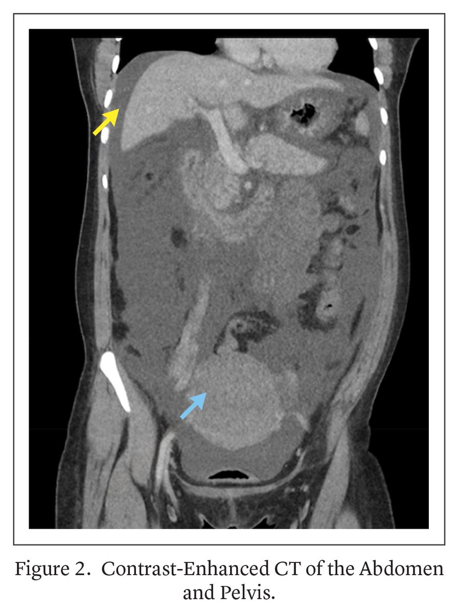NEJM Evidence (@nejmevidence) on Twitter photo A 29-year-old woman presented with jaundice a few days after delivering an infant at home. 🏥 How do you approach the evaluation, and what is the differential diagnosis? Read the Morning Report: eviden.cc/4lcyfkK
<a href="/toryappleby/">Tory Appleby</a> #MedTwitter A 29-year-old woman presented with jaundice a few days after delivering an infant at home. 🏥 How do you approach the evaluation, and what is the differential diagnosis? Read the Morning Report: eviden.cc/4lcyfkK
<a href="/toryappleby/">Tory Appleby</a> #MedTwitter