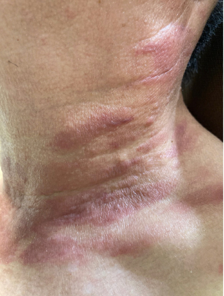 Annals of Internal Medicine: Clinical Cases (@annalsofimcc) on Twitter photo A report details a rare case of cutaneous metastases in a patient with lung adenocarcinoma complicated by acute respiratory failure. bit.ly/3HbvfXs <a href="/AHAScience/">AHA Science</a> #AHAJournals A report details a rare case of cutaneous metastases in a patient with lung adenocarcinoma complicated by acute respiratory failure. bit.ly/3HbvfXs <a href="/AHAScience/">AHA Science</a> #AHAJournals