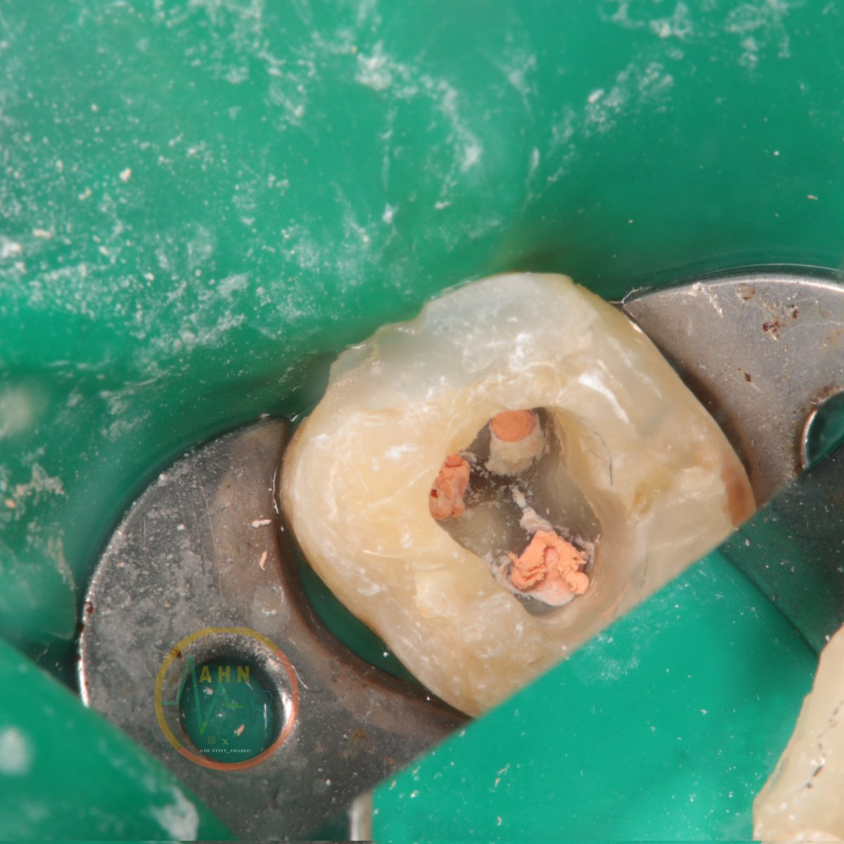 dentist_amar617's tweet image. الم سن يصحي من النوم  
علاج عصب لطاحن سفلي متبوع  بحشوة تجهيزا لعمل تلبيسة
RCT for lower right 2nd molar #47 canal sahped to size x2 and fulled with GP and #bioceramic sealer  then filled with composite  and ready for crowning 
#saveatooth 
Scroll down for final result