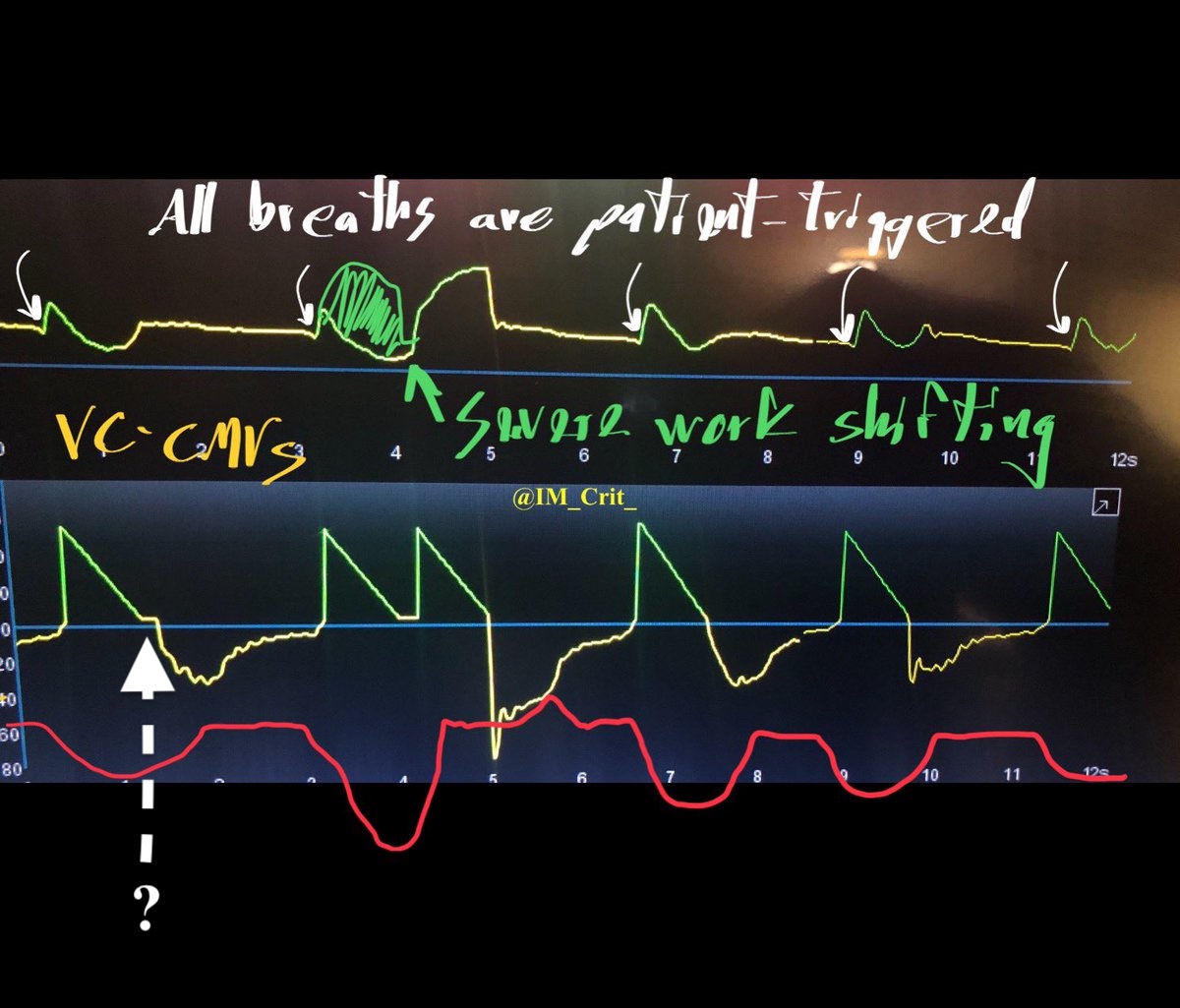 IMCrit (@im_crit_) on Twitter photo This was VC-CMVs (aka, "volume-control"; in this case each breath was given with decelerating/ramp flow, not constant/square flow) & all the undesirable patient-ventilator interactions were nicely depicted by <a href="/DrMiguelIbarra1/">Dr. Miguel Ibarra-Estrada</a>. Early cycling was at the core of the problem This was VC-CMVs (aka, "volume-control"; in this case each breath was given with decelerating/ramp flow, not constant/square flow) & all the undesirable patient-ventilator interactions were nicely depicted by <a href="/DrMiguelIbarra1/">Dr. Miguel Ibarra-Estrada</a>. Early cycling was at the core of the problem