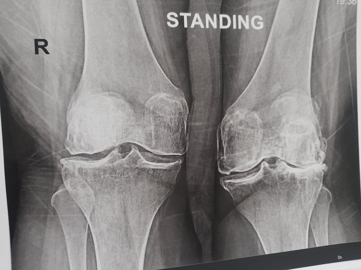 Anhedonya (@psanhedonya) on Twitter photo 🆘 <a href="/yasmeenzak88837/">yasmeen zaki</a> was evacuated to 🇪🇬 for surgery after she lost her husband/home. Rheumatoid Arthritis ruined her hip/knee joint + ability to walk. We can help⬇️
🔹RA Treatment
🔹Monthly Rent
🔹Total Knee
- Replacement
📢 GET HER TO £2⃣k❕
✅ chuffed.org/project/121825 ✅ 🆘 <a href="/yasmeenzak88837/">yasmeen zaki</a> was evacuated to 🇪🇬 for surgery after she lost her husband/home. Rheumatoid Arthritis ruined her hip/knee joint + ability to walk. We can help⬇️
🔹RA Treatment
🔹Monthly Rent
🔹Total Knee
- Replacement
📢 GET HER TO £2⃣k❕
✅ chuffed.org/project/121825 ✅